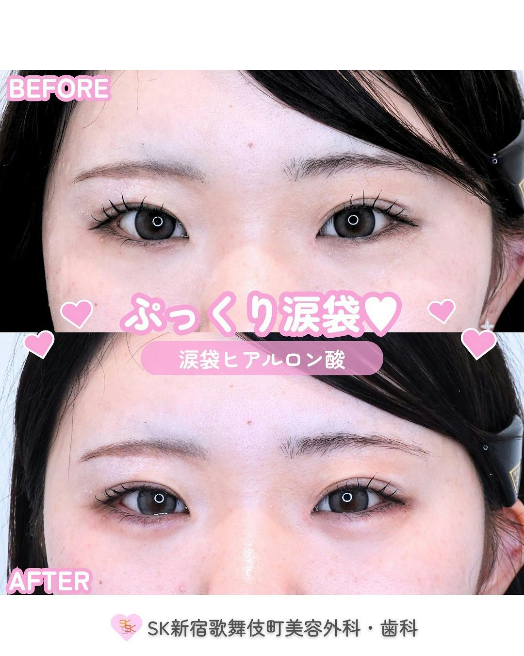 【女性・目元】涙袋ヒアルロン酸_before_aftar