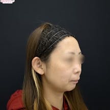 【女性・小顔】美ボディ脂肪吸引_before