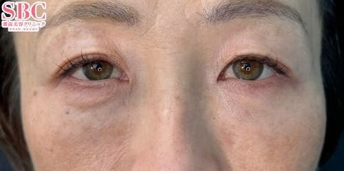 【40代女性・クマ】目の下の切らないクマ・たるみ（ふくらみ）取り、ナチュラル脂肪注射ナノリッチ、ナチュラル脂肪注射コンデンスリッチ_after