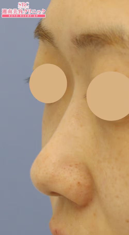 【女性・鼻】SBCプレミアムソフトプロテーゼ_before