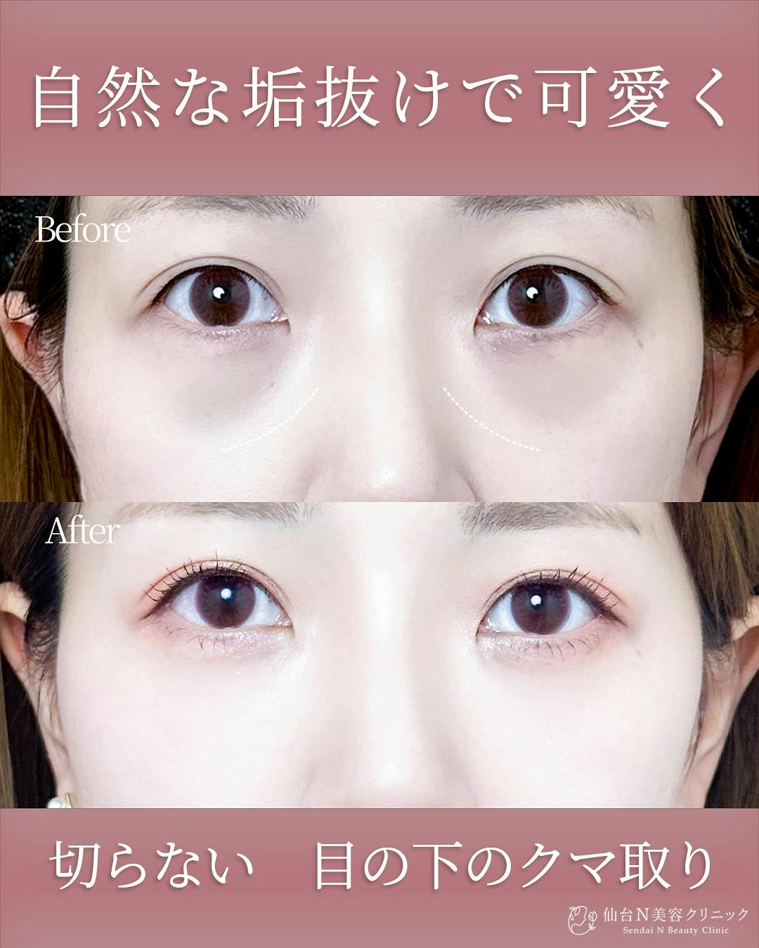 【女性・クマ】切らないクマとり_before_aftar