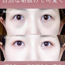 【女性・クマ】切らないクマとり_before_aftar