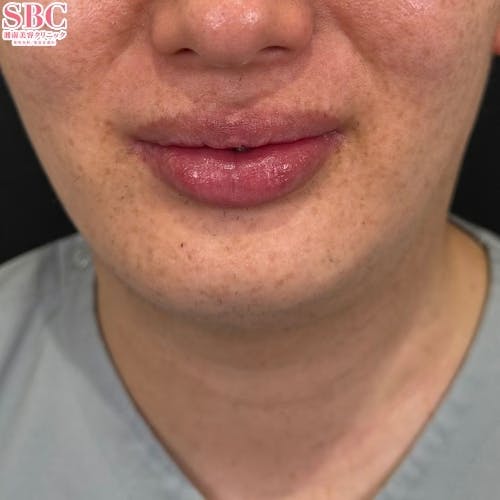 【しわ】ボトックス（アラガン）_after