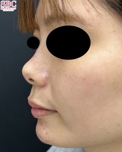 【女性・輪郭】ヒアルロン酸ウルトラディープ_after