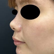 【女性・輪郭】ヒアルロン酸ウルトラディープ_after