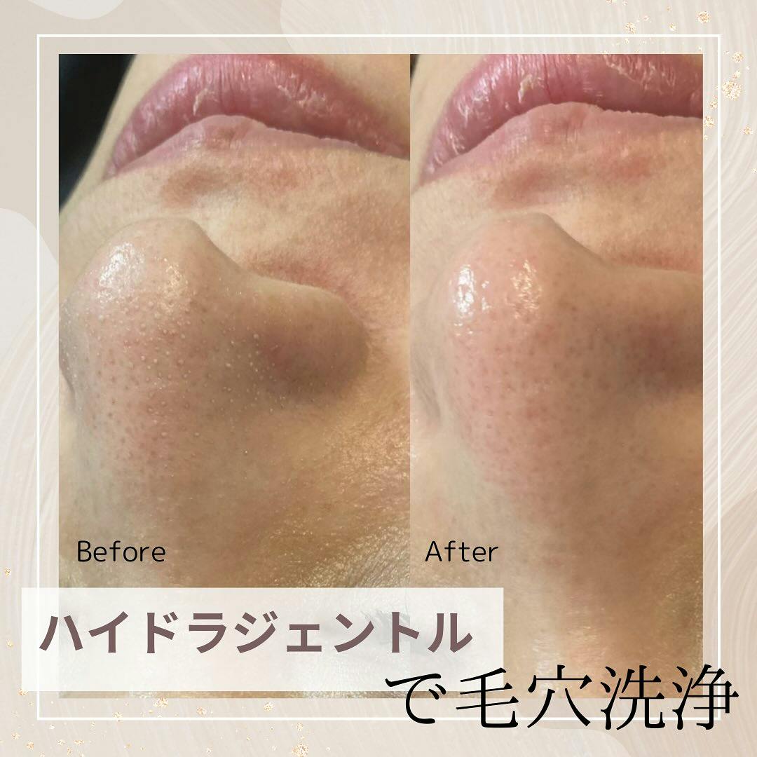 【女性・毛穴】ハイドラジェントル_before_aftar