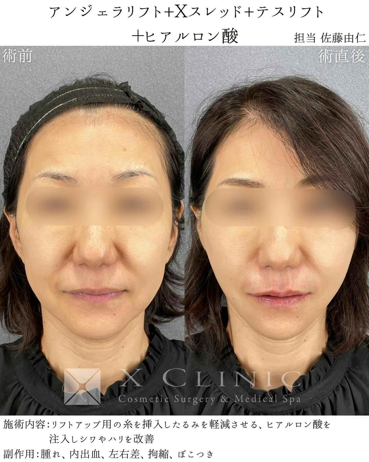 【女性・輪郭】アンジェラリフト エックススレッド テスリフト ヒアルロン酸_before_aftar