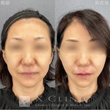 【女性・輪郭】アンジェラリフト エックススレッド テスリフト ヒアルロン酸_before_aftar