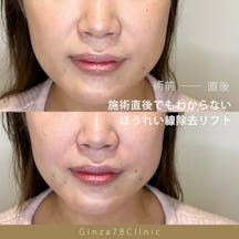 【女性・ほうれい線】スマイルラインスレッド_before_aftar