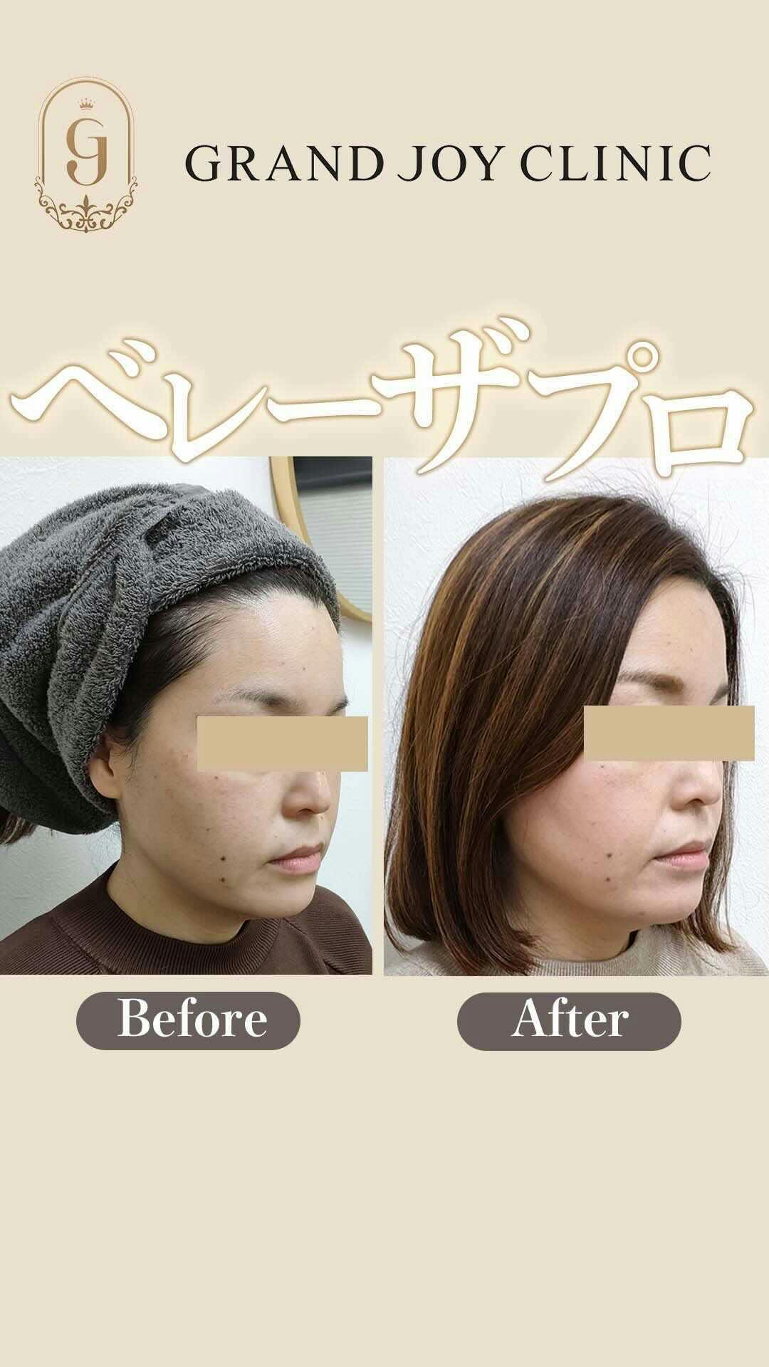 【女性・輪郭】ベレーザプロ_before_aftar