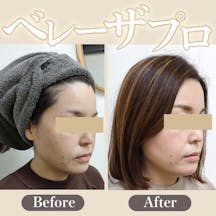 【女性・輪郭】ベレーザプロ_before_aftar