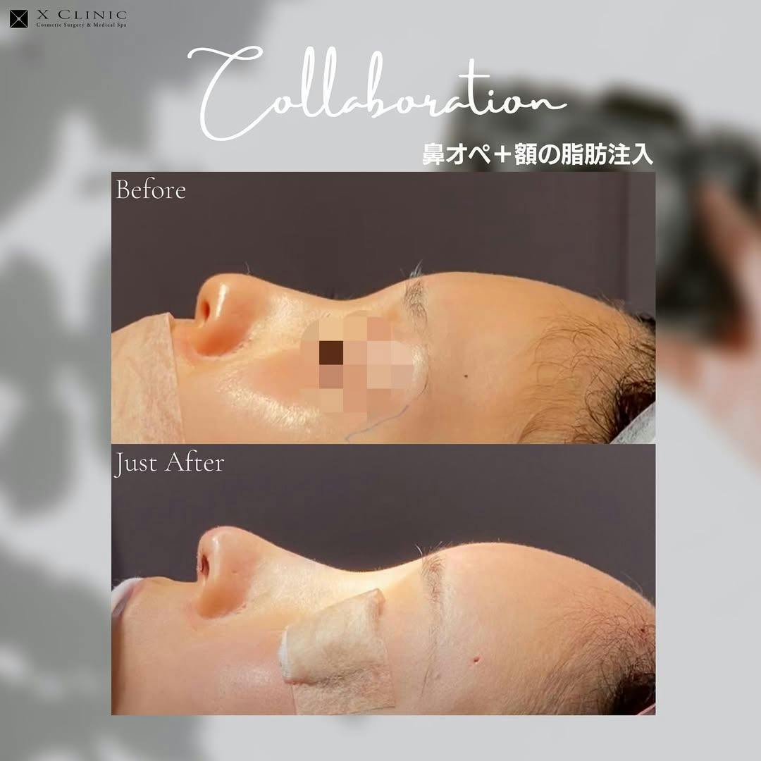 【女性・輪郭】鼻オペ+額の脂肪注入_before_aftar