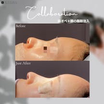 【女性・輪郭】鼻オペ+額の脂肪注入_before_aftar