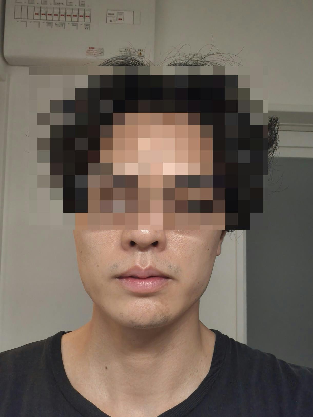 SBC NEO Skin Clinic 恵比寿でヒゲ脱毛を受けたk..yamaguchiさんの写真