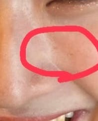 ゼクスクリニック(ZX-CLINIC)でシミ取りレーザーを受けたみやさんの写真