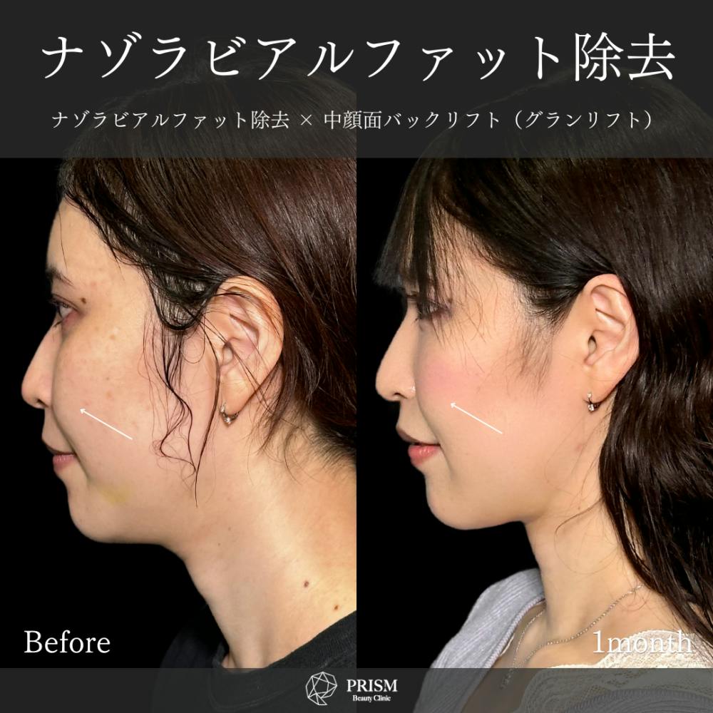 【30代女性・顔】ナゾラビアルファット除去 ＋中顔面バックリフト（ 糸リフト）_before_aftar