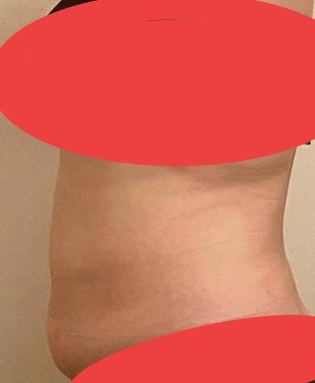 AND美容外科 名古屋院で脂肪冷却：ANDスタンダードを受けたみゆきさんの写真