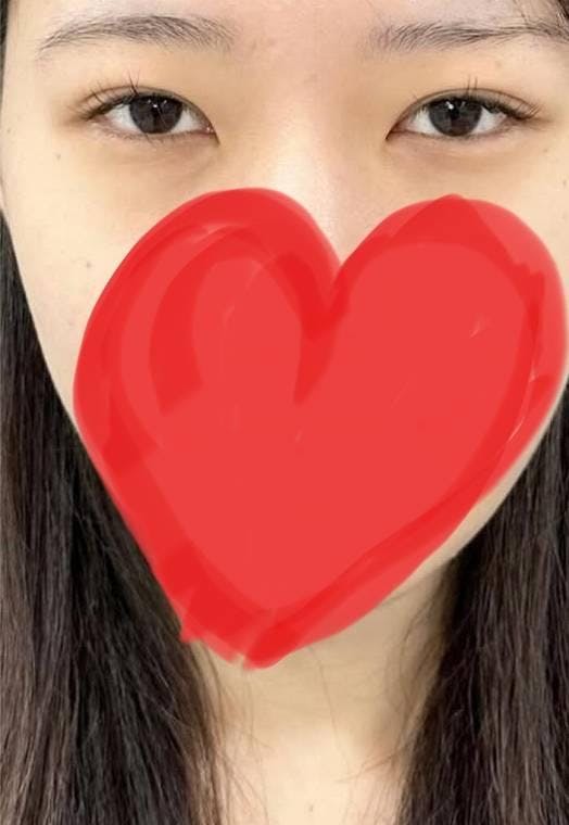 湘南美容クリニック 横浜院で目元整形：白目整形＋クマ取り再生術＋二重術クイックコスメティークNeoを受けたピアノさんの写真
