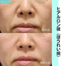 【女性・ほうれい線】ヒアルロン酸注入_before_aftar