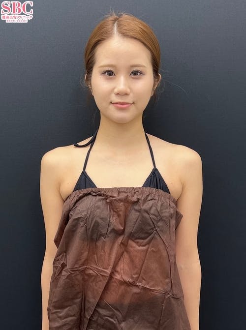 【女性・二の腕】Aquicell（アキーセル）脂肪吸引_before