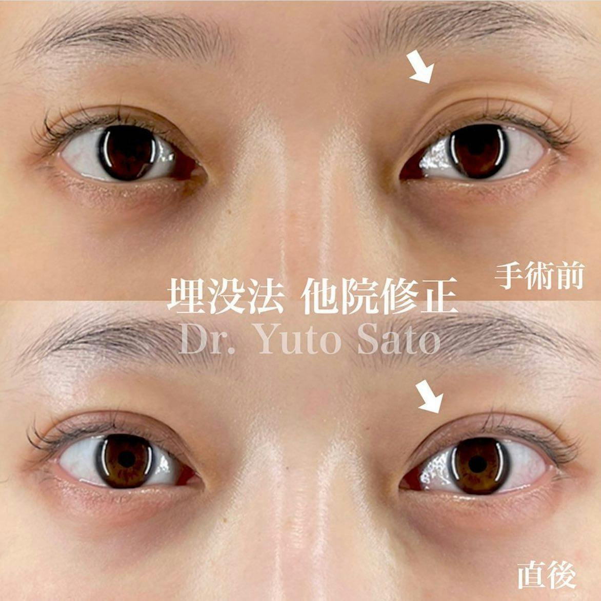 【女性・目元】Xクロスダブル(両目) デカ目術(切らない眼瞼下垂術)_before_aftar