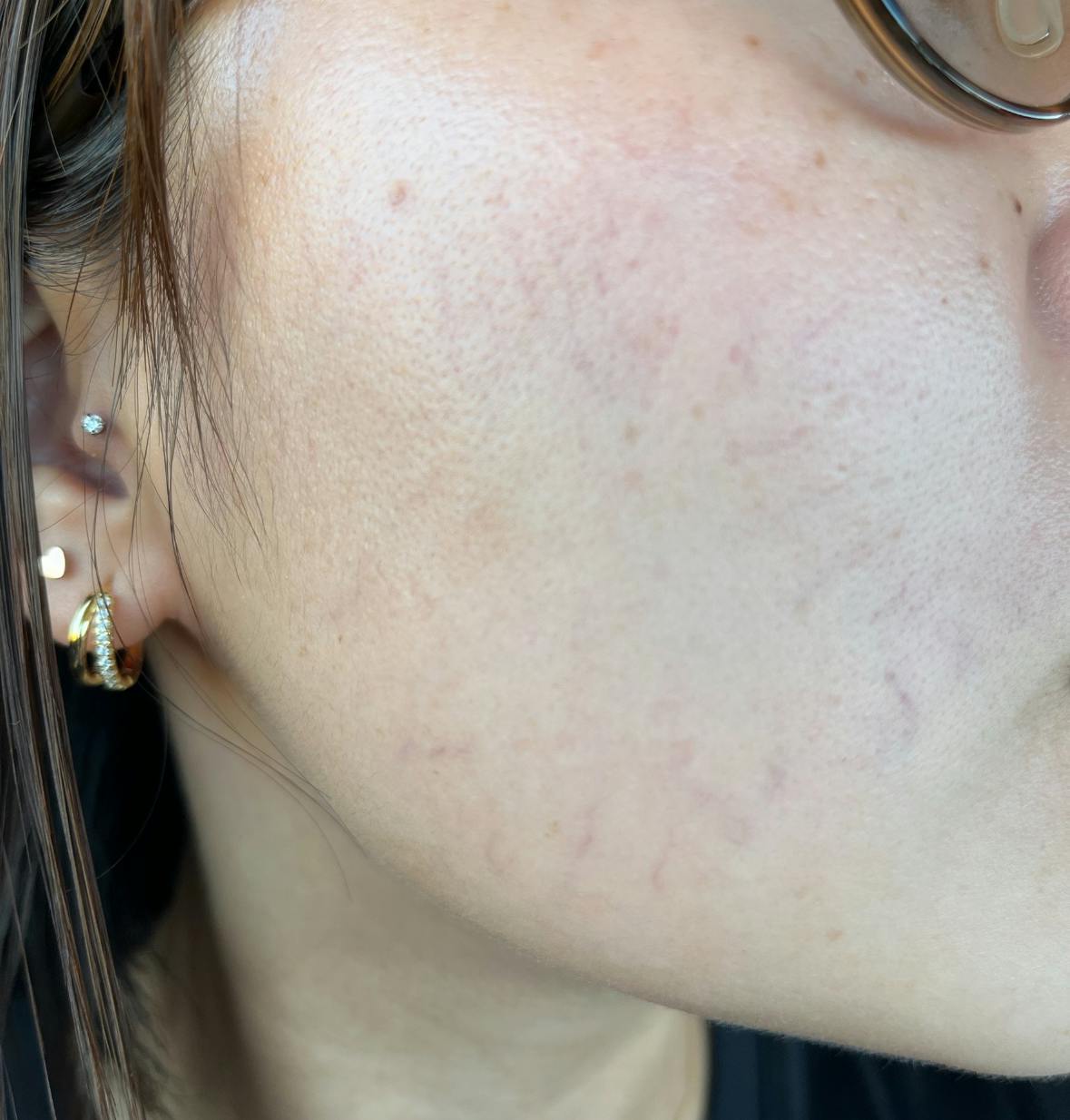 よつば会クリニック 神戸・ハーバーランド院でを受けたまゆさんの写真