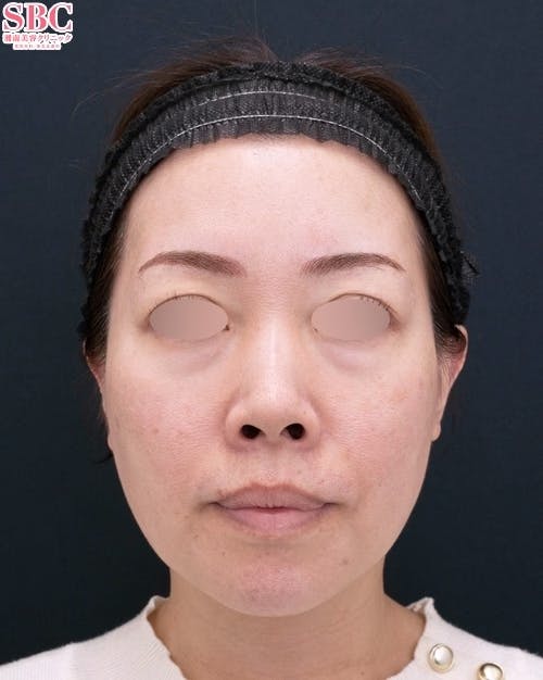 【40代女性・顔】Aquicell（アキーセル）脂肪吸引、ジョールファット除去術、ボトックス、目の下の切らないクマ・たるみ取り 、コンデンスリッチフェイス法 、ナノリッチ、SBCプリマリフト、シークレットリフト_before