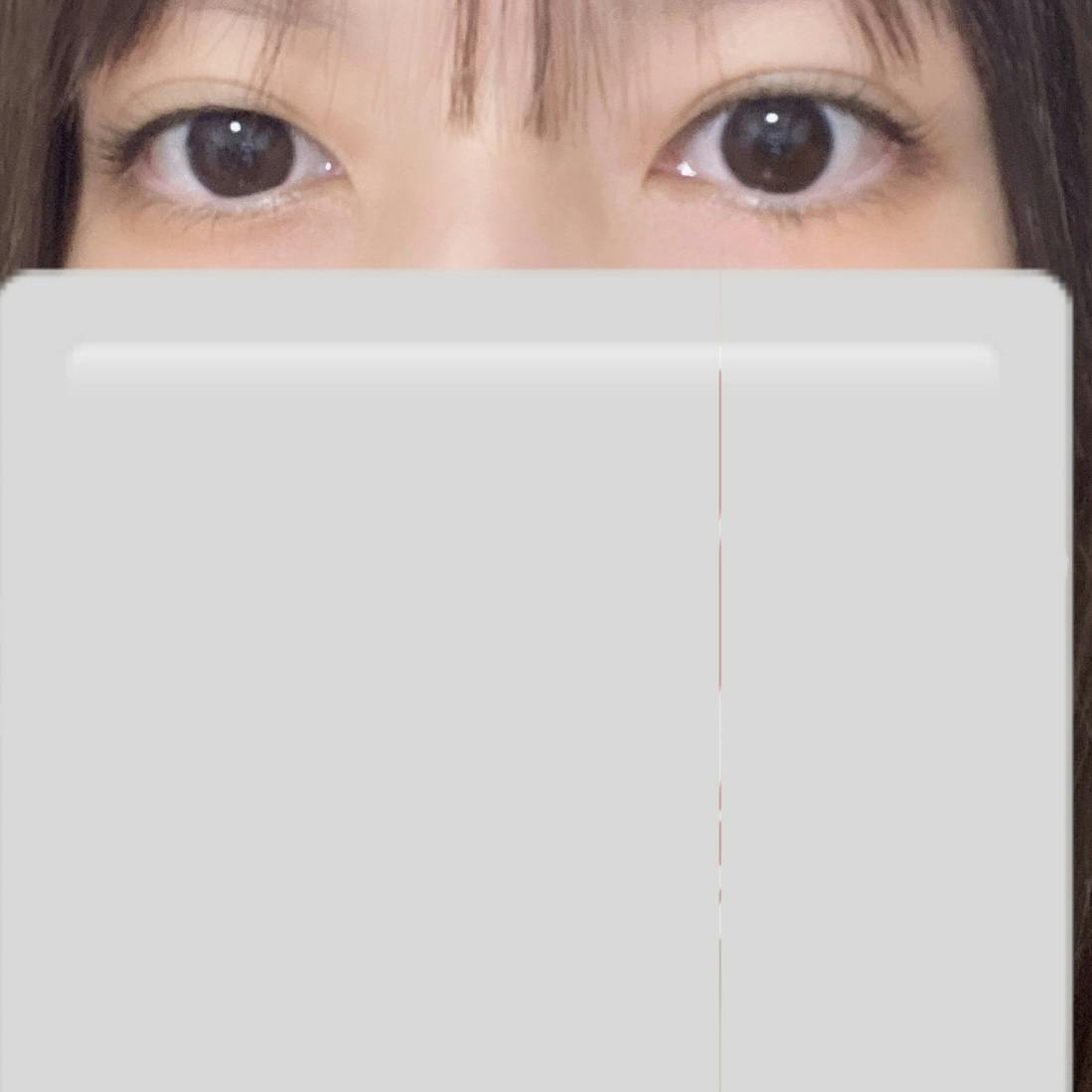 湘南美容クリニック 柏院で二重整形・二重埋没・奥二重整形・末広二重整形・平行二重整形・ミックス型二重整形・目元整形を受けたねこさんの写真