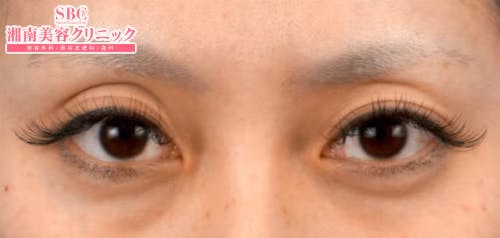 【30代女性・目元】クイックコスメティーク・ダブルNeo_before