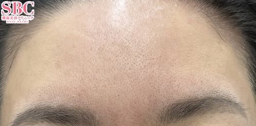 【女性・額・眉間】女優注射(R)~リジュランi＋ボトックス~_before