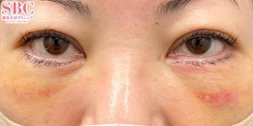 【女性・クマ】切開ハムラ(表ハムラ)法_1week