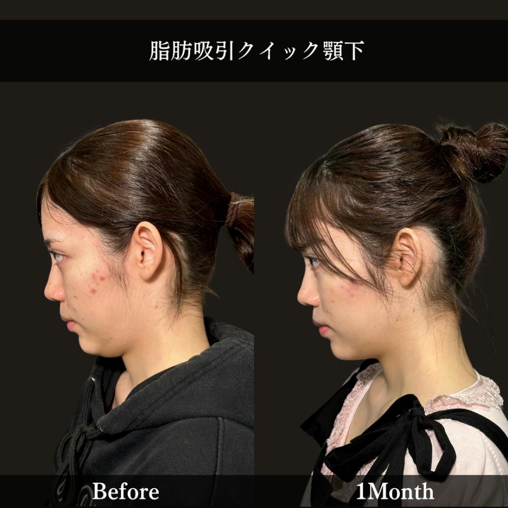 【20代女性・顎】脂肪吸引クイック（あご下）_before_aftar