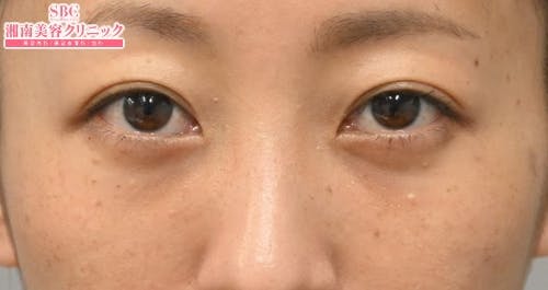 【30代女性・目元】目の下の切らないクマ・たるみ（ふくらみ）取り ナチュラル脂肪注射コンデンスリッチ ナチュラル脂肪注射ナノリッチ_after
