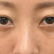 【30代女性・目元】目の下の切らないクマ・たるみ(ふくらみ)取り ナチュラル脂肪注射コンデンスリッチ ナチュラル脂肪注射ナノリッチ_after