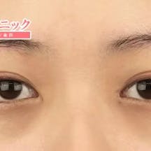 【女性・目元】眉下リフト(眉下切開)目頭切開プレミアム_after