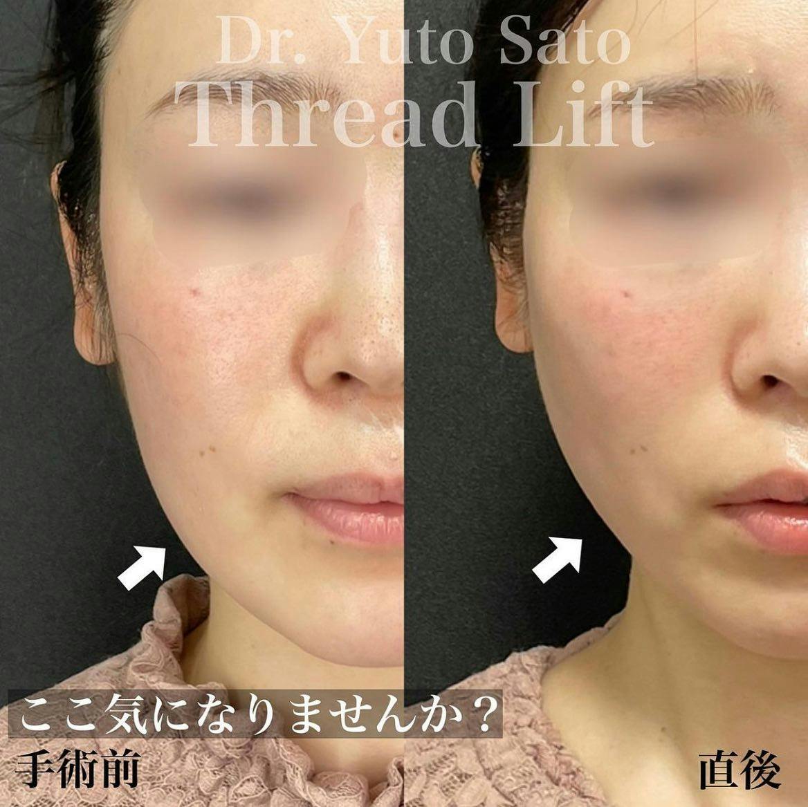 【女性・輪郭】糸リフト_before_aftar