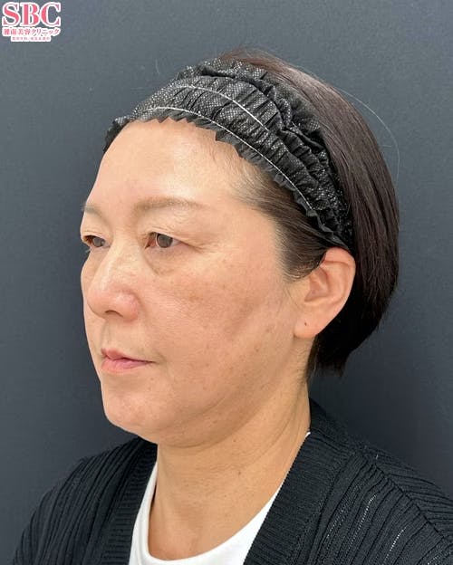 【50代女性・顔・目元】プリマリフト・目の下の切らないクマ・たるみ(ふくらみ)取り・ナチュラル脂肪注射コンデンスリッチ_before