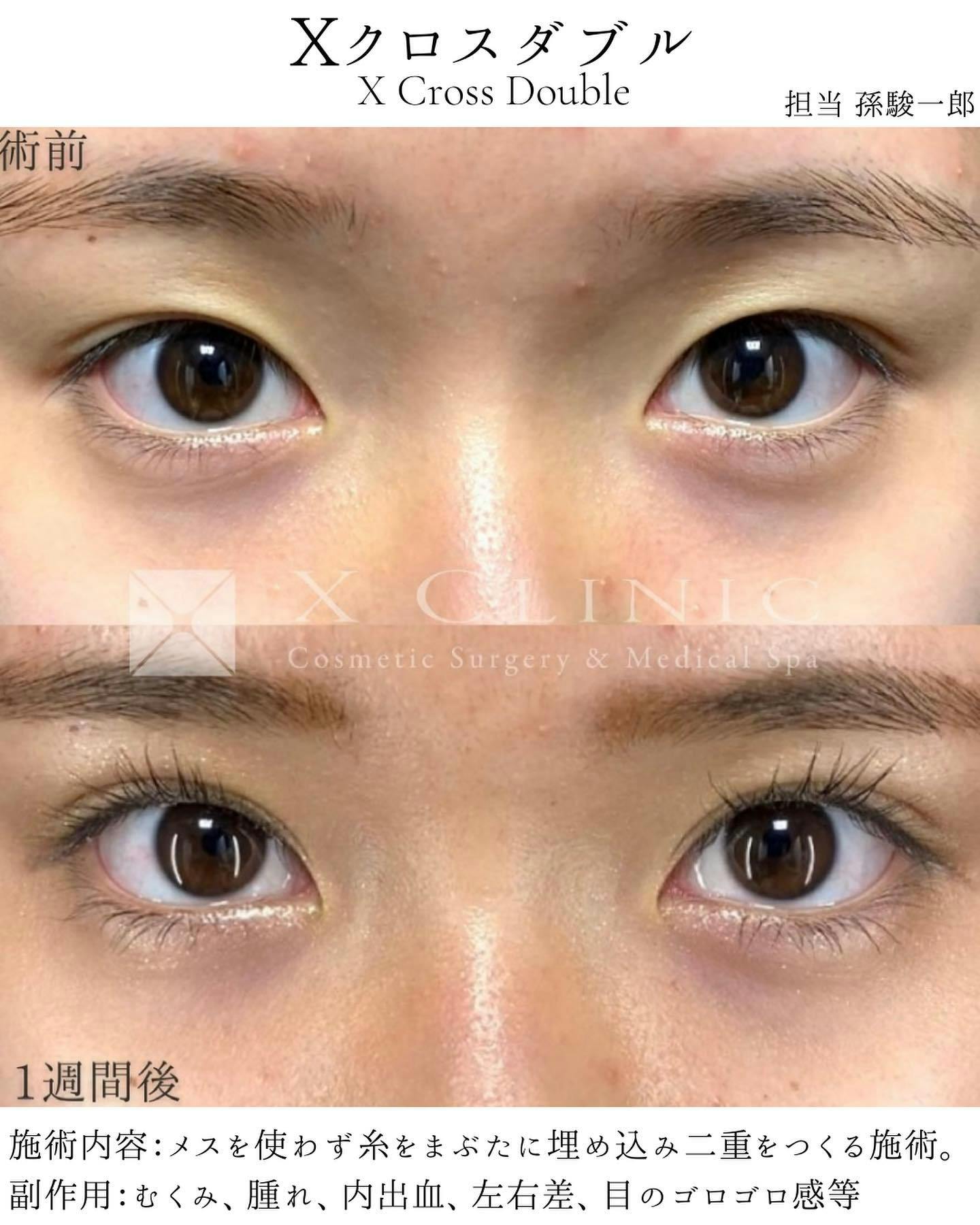 【女性・目元】エックスクロスダブル_before_aftar