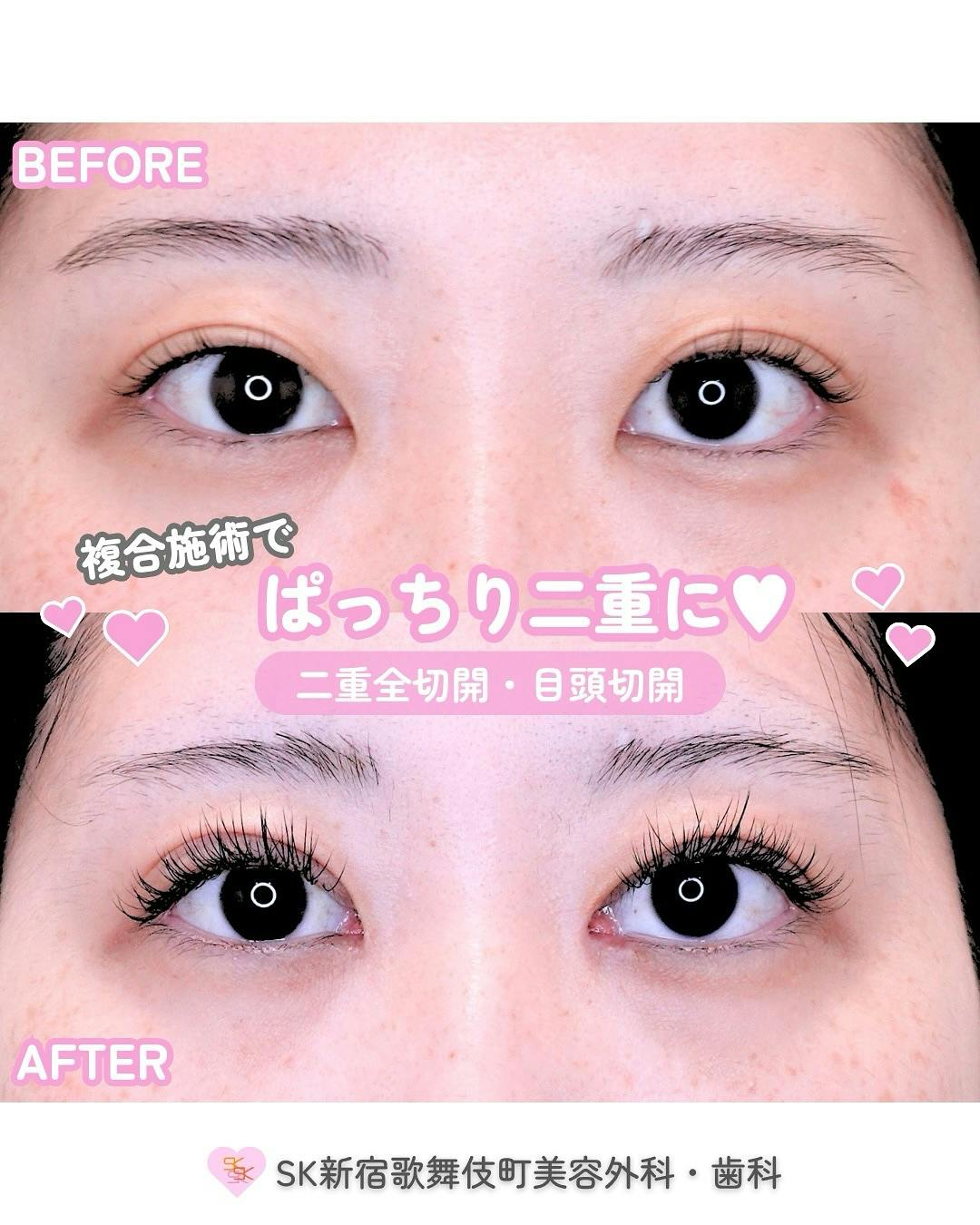 【女性・目元】二重全切開・目頭切開_before_aftar