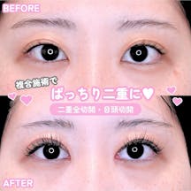 【女性・目元】二重全切開・目頭切開_before_aftar