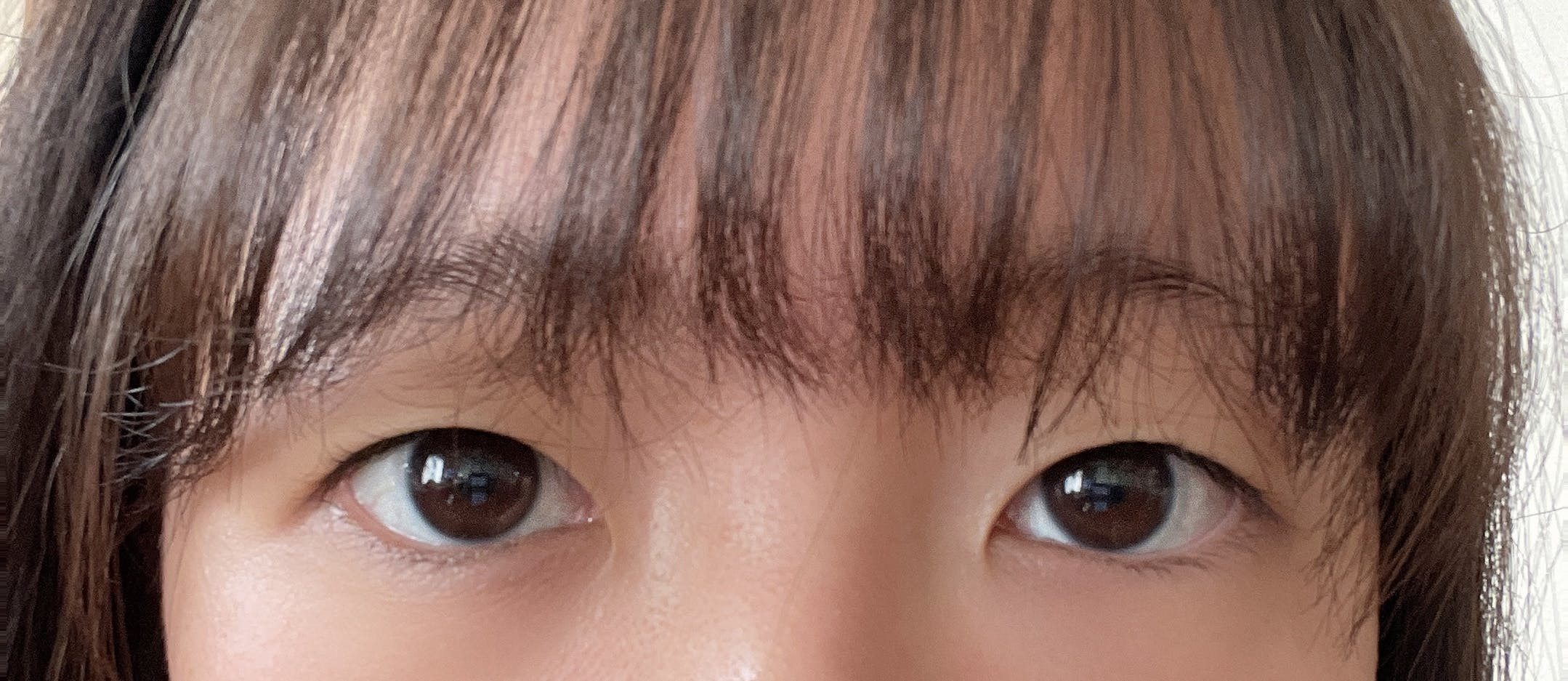 湘南美容クリニック 岡山院で二重整形・二重埋没・奥二重整形・末広二重整形・平行二重整形・ミックス型二重整形・目元整形を受けたちーさんの写真