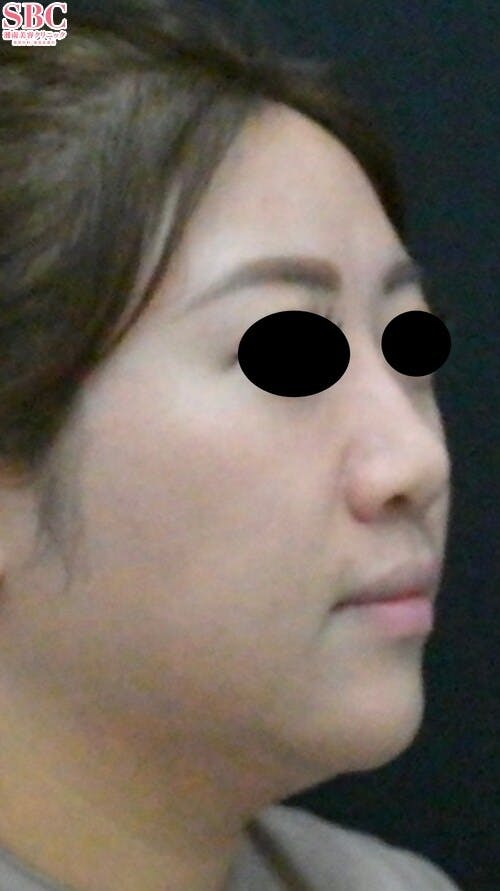 【女性・輪郭】ヒアルロン酸ウルトラディープ・ヒアルロン酸ジュビダームビスタ バイクロスシリーズ_after