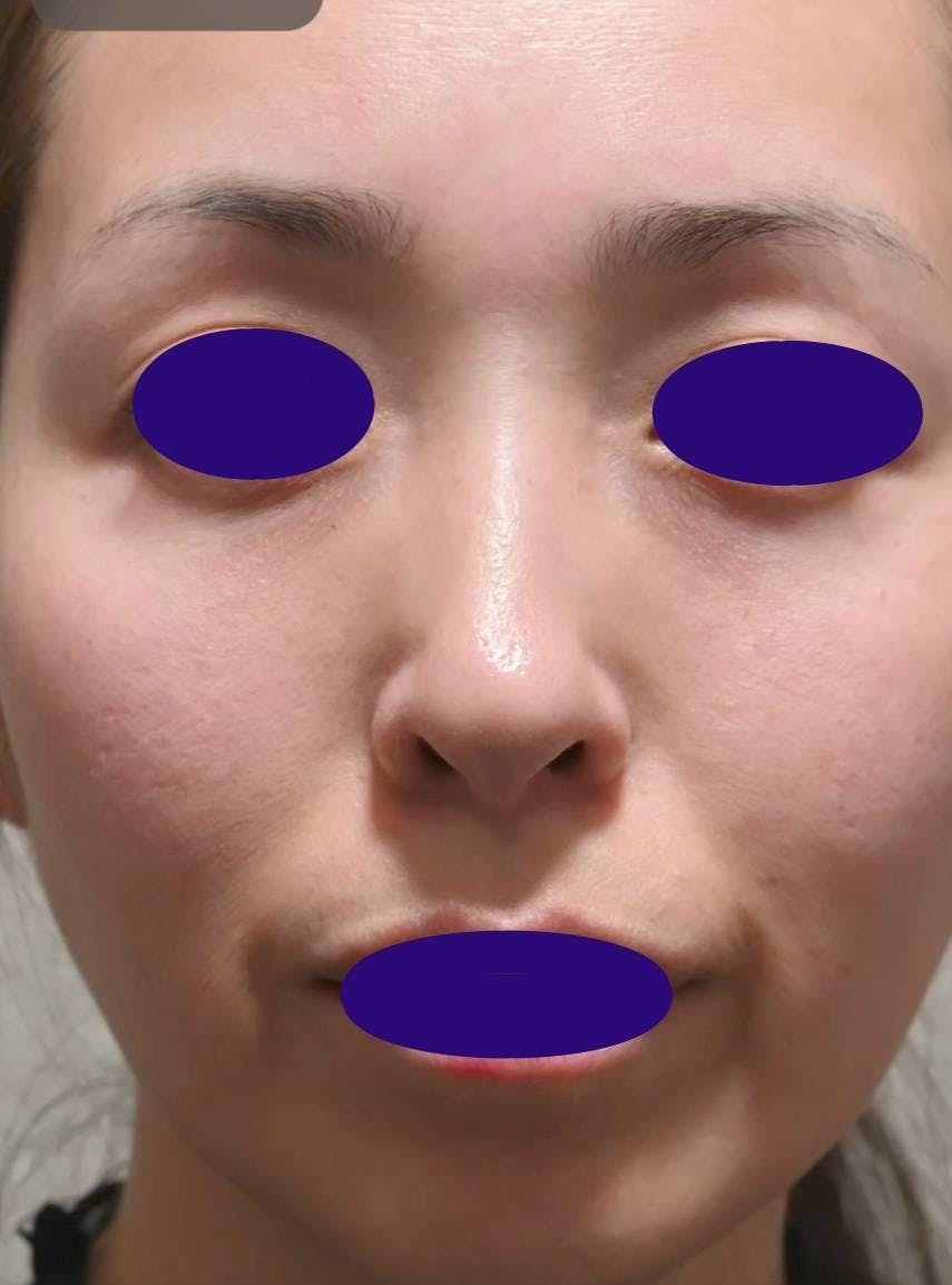 水の森美容クリニック 東京新宿院で目の下のたるみ・クマ取り：裏ハムラ法を受けたフェイさんの写真