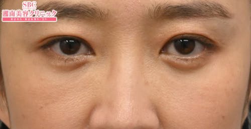 【40代女性・目元】目の下の切らないクマ・たるみ（ふくらみ）取り ナチュラル脂肪注射コンデンスリッチ ナチュラル脂肪注射ナノリッチ_after