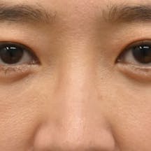 【40代女性・目元】目の下の切らないクマ・たるみ(ふくらみ)取り ナチュラル脂肪注射コンデンスリッチ ナチュラル脂肪注射ナノリッチ_after