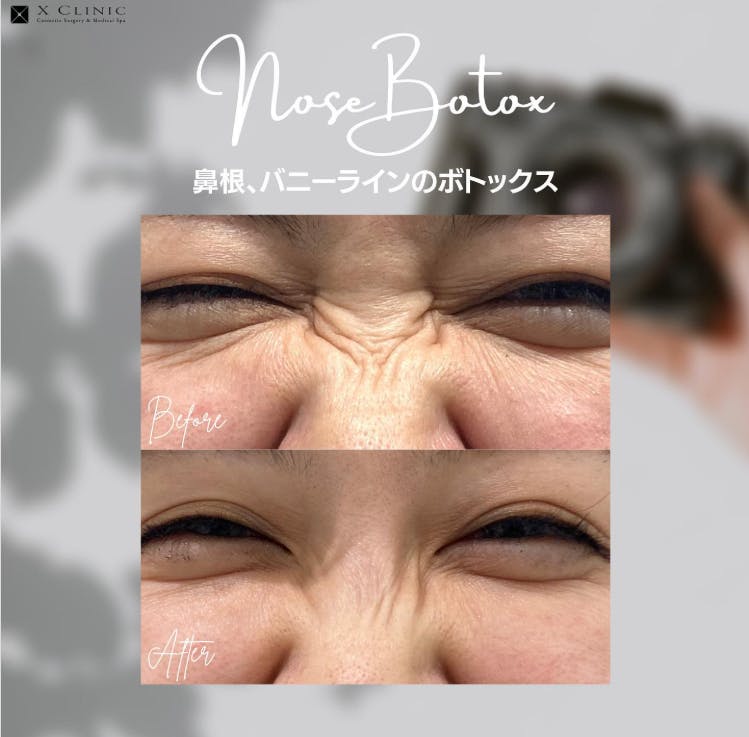 【女性・シワ】鼻根、バニーラインのボトックス_before_aftar