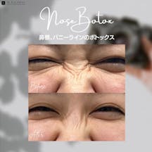 【女性・シワ】鼻根、バニーラインのボトックス_before_aftar