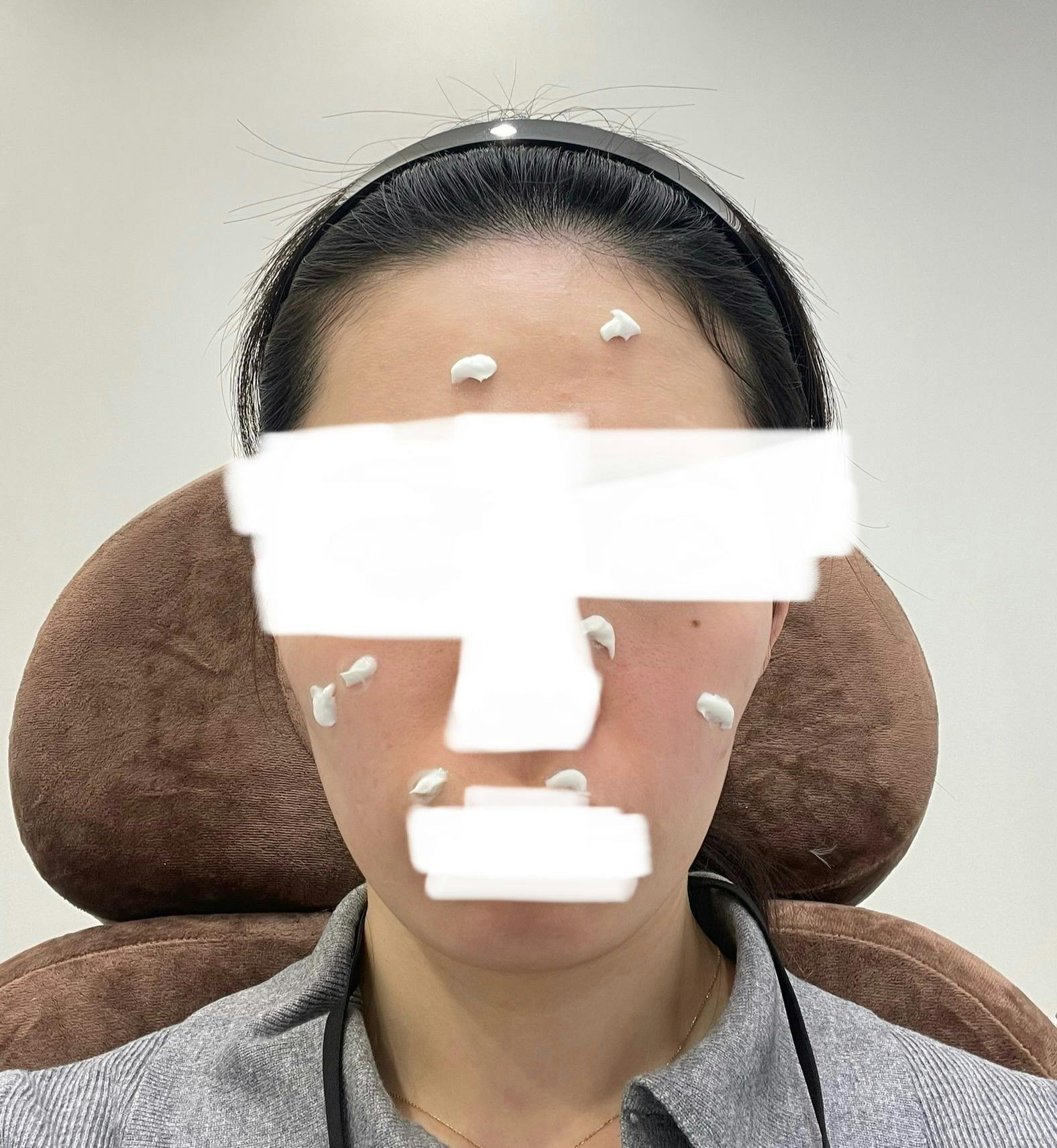 ベンスクリニック新宿でを受けたminさんの写真