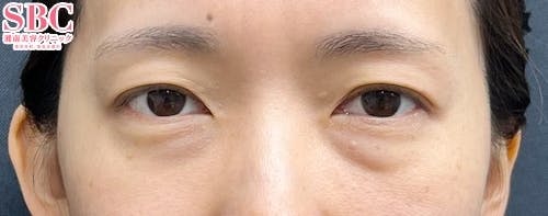 【40代女性・目元】ナチュラル脂肪注射コンデンスリッチ、ナチュラル脂肪注射ナノリッチ、目の下の切らないクマ・たるみ（ふくらみ）取り_before