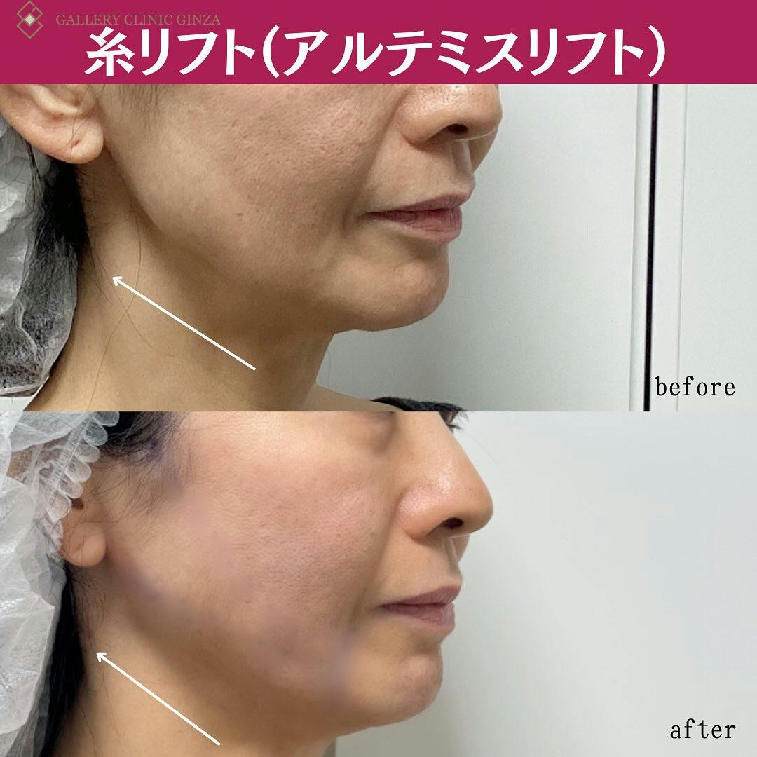 【女性・たるみ】糸リフト(アルテミスリフト)_before_aftar